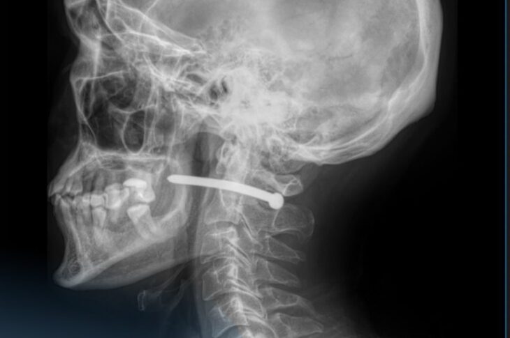 Врачи Петропавловска спасли мужчину с гвоздем в шее